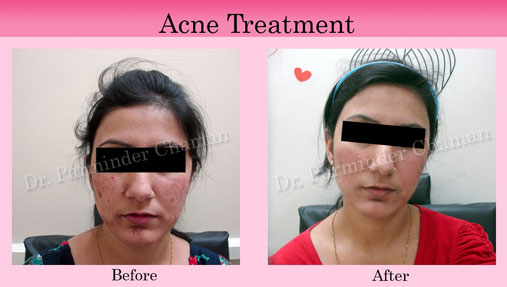 Skin Specialist for Acne