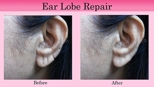 Stitchless Ear Lobe Repair Punjab