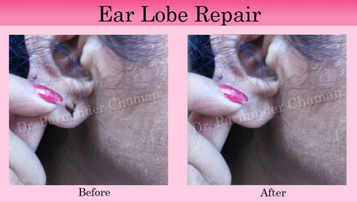 Cosmetic Ear Repair in Chandigarh