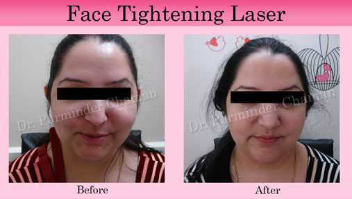 Laser Skin Tightening Clinic