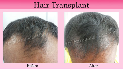 Hair Treatment in Chandigarh