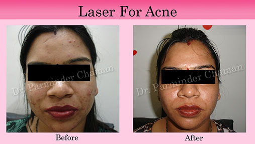 Laser Scar Removal in Chandigarh