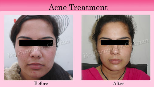 Acne Removal