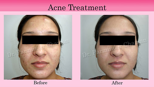 Best Dermatologist in Chandigarh