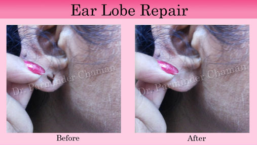 Stitchless Ear Lobe Repair Chandigarh