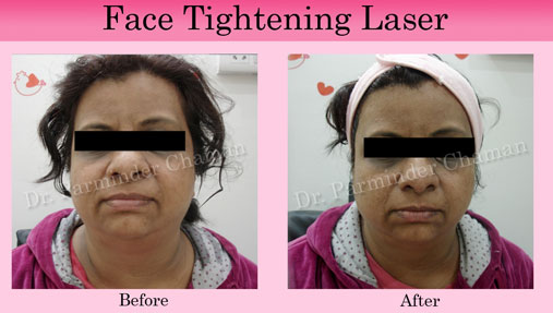 Skin Tightening Clinic in Chandigarh