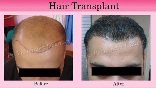 Hair Transplant in Chandigarh