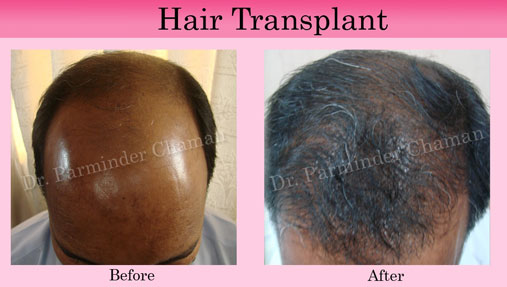 PRP for Hair Treatment