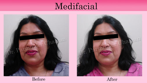 Dermaroller in Chandigarh | Medi facial in Chandigarh