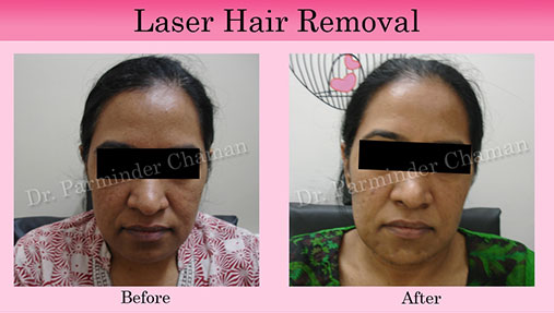 Permanent Hair Removal