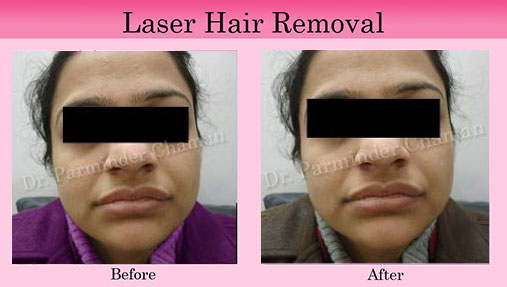 Skin Doctor for Hair Removal