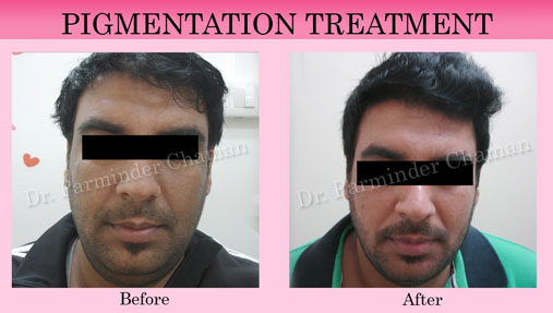 Dermatologist in Chandigarh