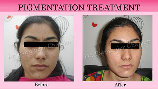 Best Skin Specialist in Chandigarh