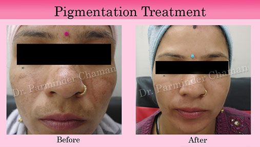 Best Skin Specialist in Chandigarh