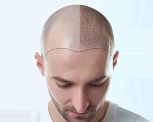 Hair Transplant in Chandigarh